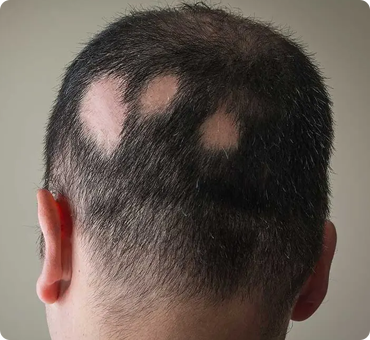 tattoo-scalp