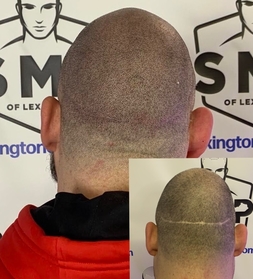 scalp-micropigmentation-Louisville