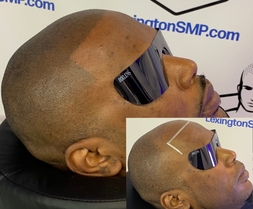 scalp-micropigmentation-TN