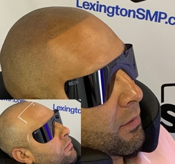 scalp-micropigmentation-Indiana