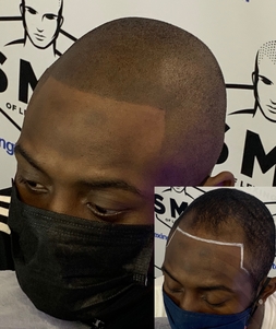 scalp-micropigmentation-Tennessee