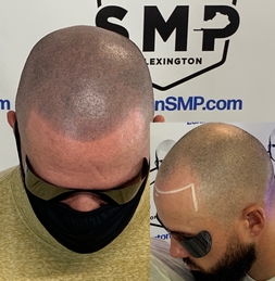 scalp-micropigmentation-Knoxville