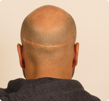 hair-loss-KY