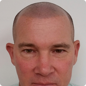 scalp-micropigmentation-Cincinnati
