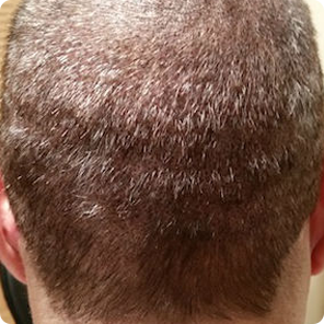 scalp-micropigmentation-Indiana