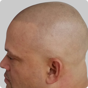 scalp-micropigmentation-Indianapolis
