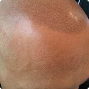 scalp-micropigmentation-KY