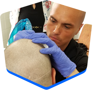 scalp-micropigmentation-Kentucky