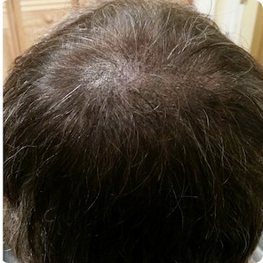 scalp-micropigmentation-Knoxville