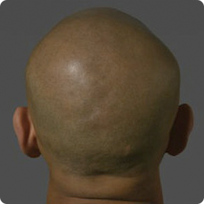 scalp-micropigmentation-Louisville