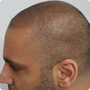 scalp-micropigmentation-TN