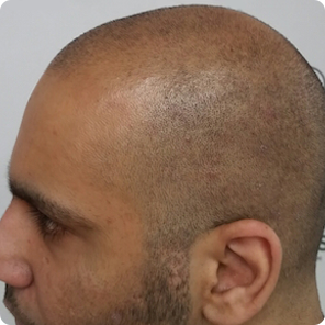 scalp-micropigmentation-Tennessee